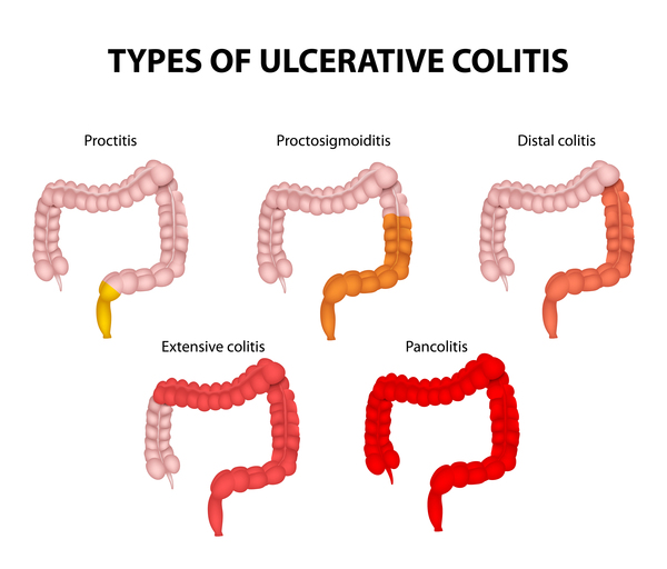 forms-of-ulcerative-colitis