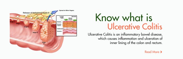 what-is-ulcerative-colitis
